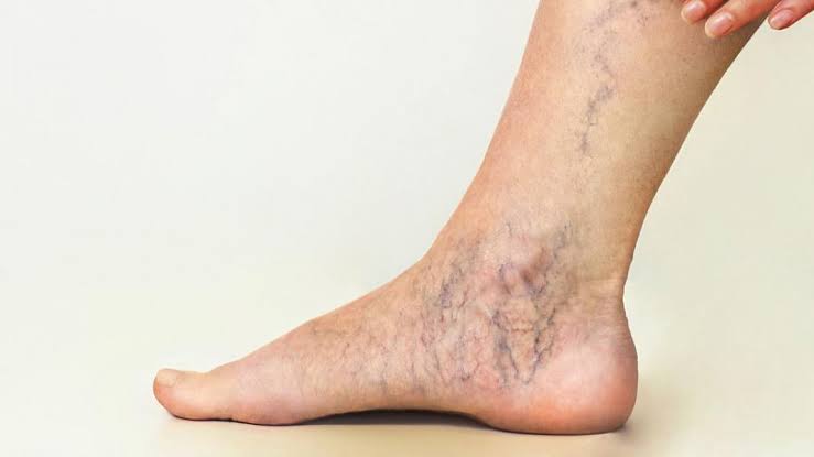 طرق طبيعية تُخفي الدوالي عند النساء